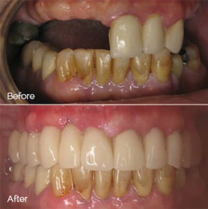 Dental Implant Before and After Photo