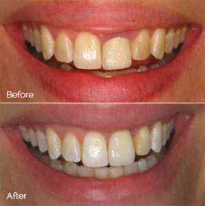 Laser Gum Treatment Before and After Photo