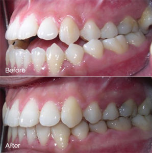 Orthodontics Before and After Photo