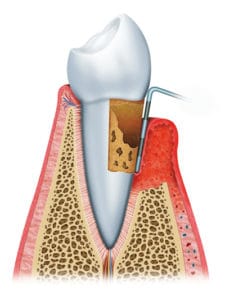 Illustration of Advanced Periodontal Disease