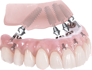 All on 4 Dental Implants Nassau County