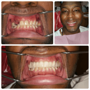 Dental Before and After Photo