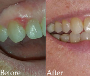 Dental Before and After Photo