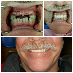 Dental Implant Before and After Photo