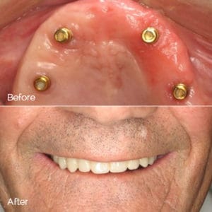 Dental Implant Before and After Photo