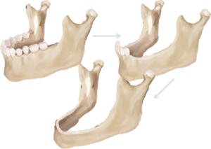 Stock Illustration of Dental Bone Loss