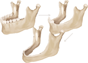 Stock Illustration of Dental Bone Loss