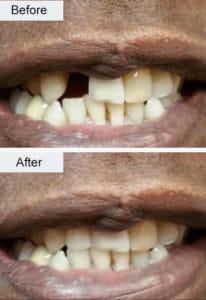 Dental Implant Before and After Photo