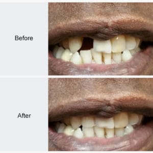 Dental Implant Before and After Photo