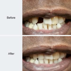 Dental Implant Before and After Photo