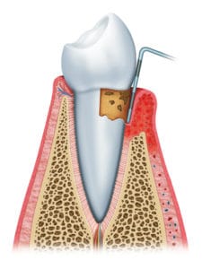 Illustration of Gingivitis