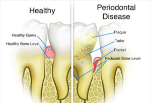 Illustration of Health and Gum Disease