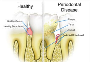 Illustration of Health and Gum Disease