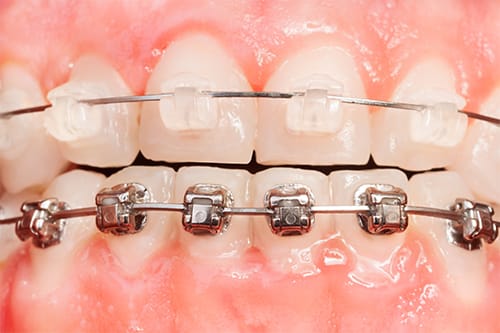 Braces | Clock Tower Dental