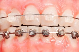 Braces, Metal VS Porcelain