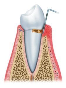 Illustration of Periodontal Disease