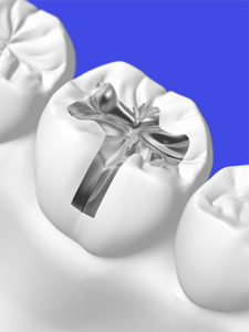 Stock Illustration of Silver Tooth Filling