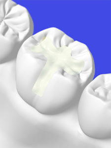 Stock Illustration of White Tooth Filling