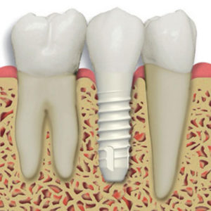 Stock Illustration of Dental implant
