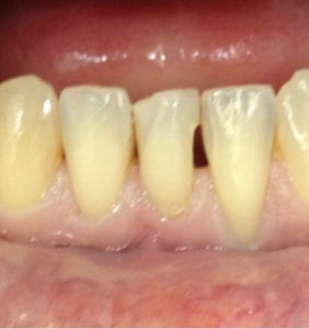 Case Study - Cosmetic Dentistry Before Image