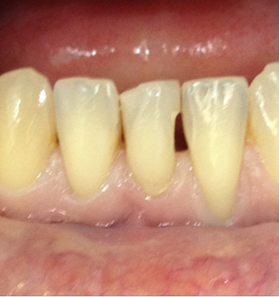 Cosmetic Dentistry – Case 16