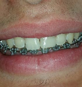 Case Study - Cosmetic Dentistry After Image
