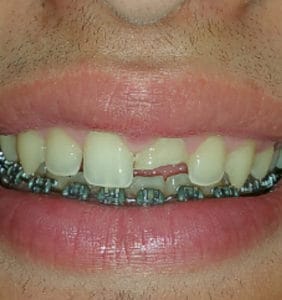 Case Study - Cosmetic Dentistry Before Image