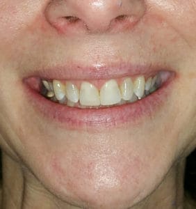 Case Study - Cosmetic Dentistry After Image