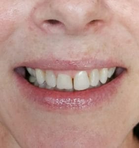 Case Study - Cosmetic Dentistry Before Image