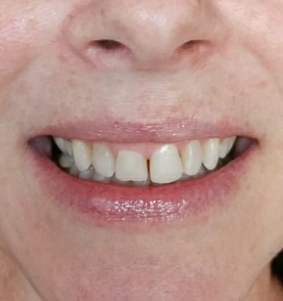 Laser Smile Correction – Case 1