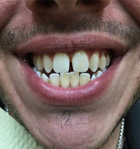 Case Study - Cosmetic Dentistry Before Image