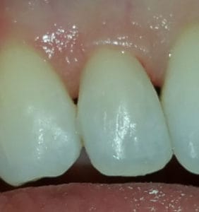 Case Study - Cosmetic Dentistry After Image