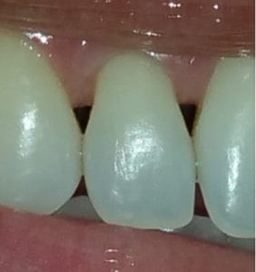 Case Study - Cosmetic Dentistry Before Image