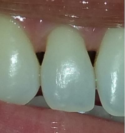 Cosmetic Dentistry – Case 9