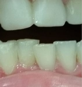 Case Study - Cosmetic Dentistry After Image