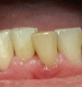 Case Study - Cosmetic Dentistry Before Image