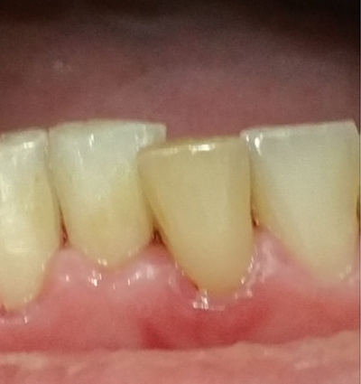 Cosmetic Dentistry – Case 10