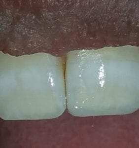 Case Study - Cosmetic Dentistry After Image