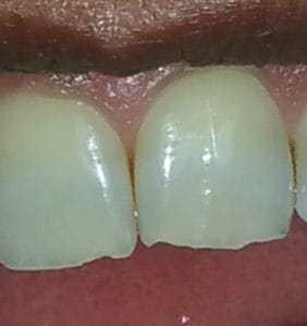Case Study - Cosmetic Dentistry Before Image