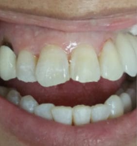 Case Study - Cosmetic Dentistry Before Image