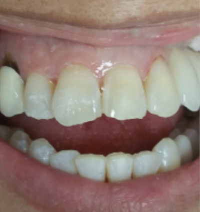 Cosmetic Dentistry – Case 12