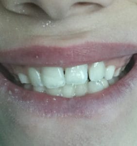 Case Study - Cosmetic Dentistry After Image