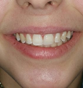 Case Study - Cosmetic Dentistry After Image