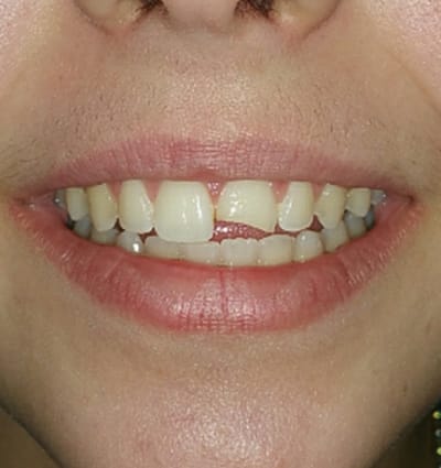 Cosmetic Dentistry – Case 15