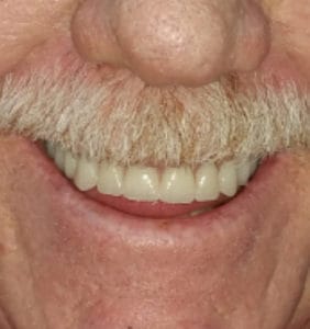 Case Study - Cosmetic Dentistry After Image