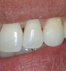 Case Study - Cosmetic Dentistry After Image