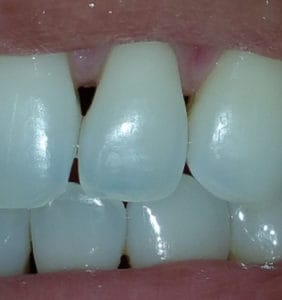 Case Study - Cosmetic Dentistry Before Image