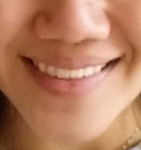 Case Study - Cosmetic Dentistry After Image