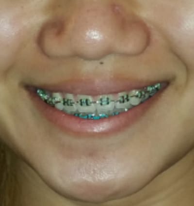 Orthodontics – Case 2