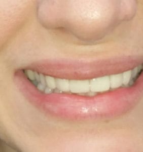 Case Study - Cosmetic Dentistry After Image